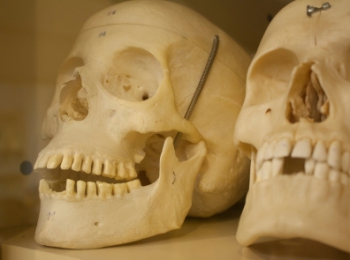 В Новосибирске начали производство 3D-заплаток для черепа